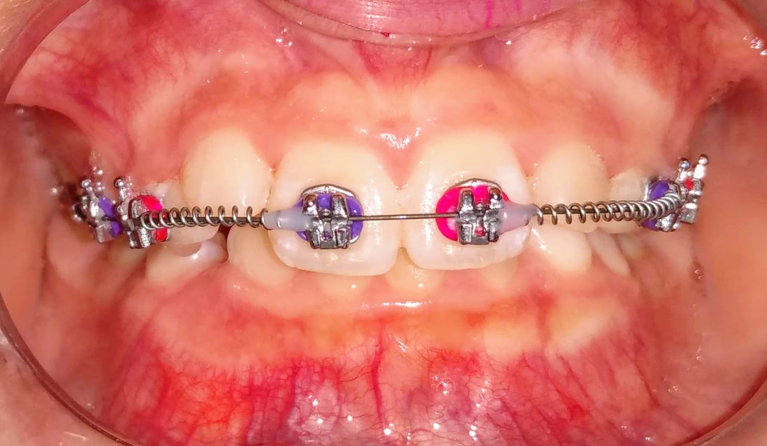 Resultado de sorriso na Demoliner Odontologia