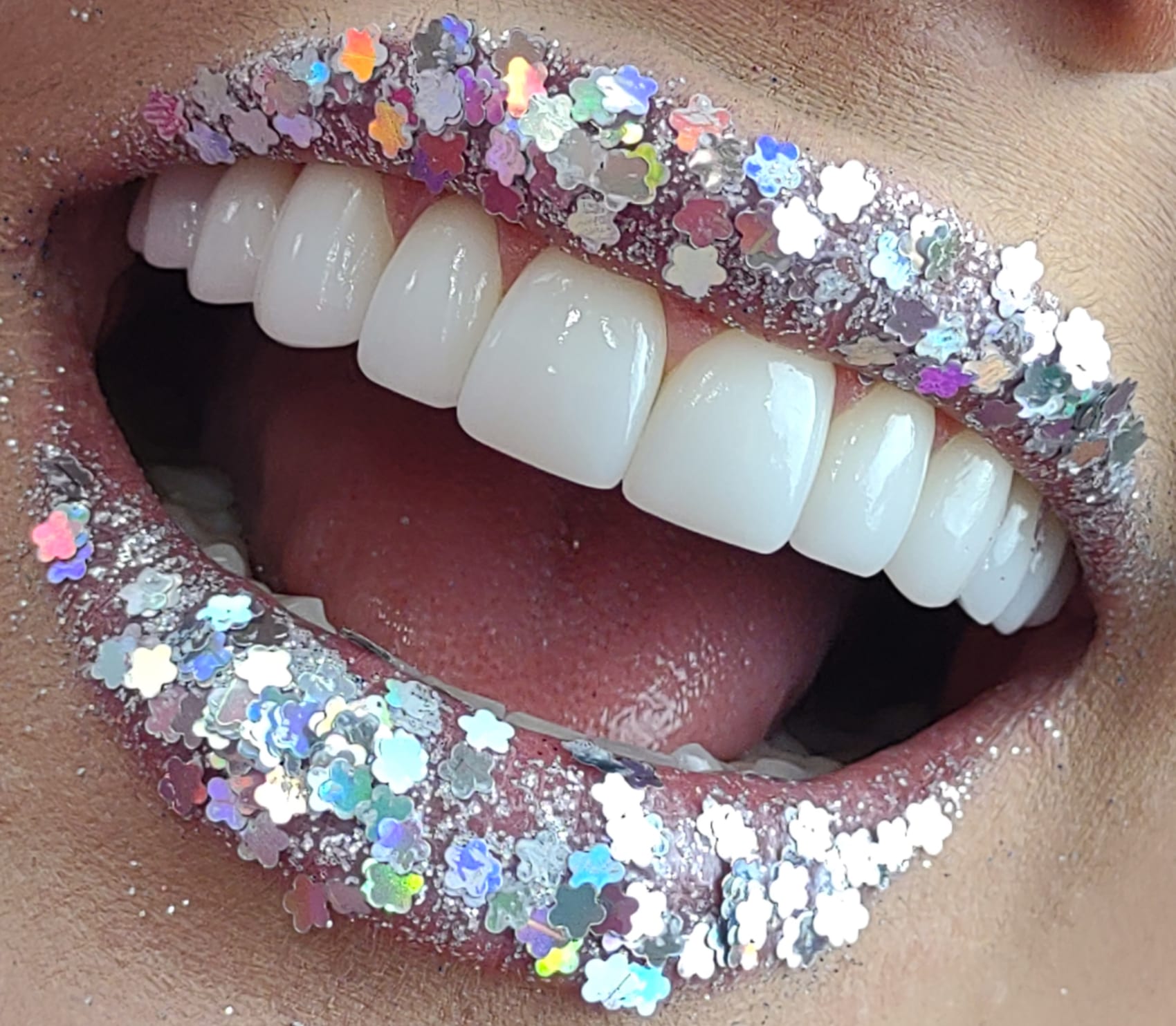 Sorriso com lentes de contato dental feito na Demoliner Odontologia