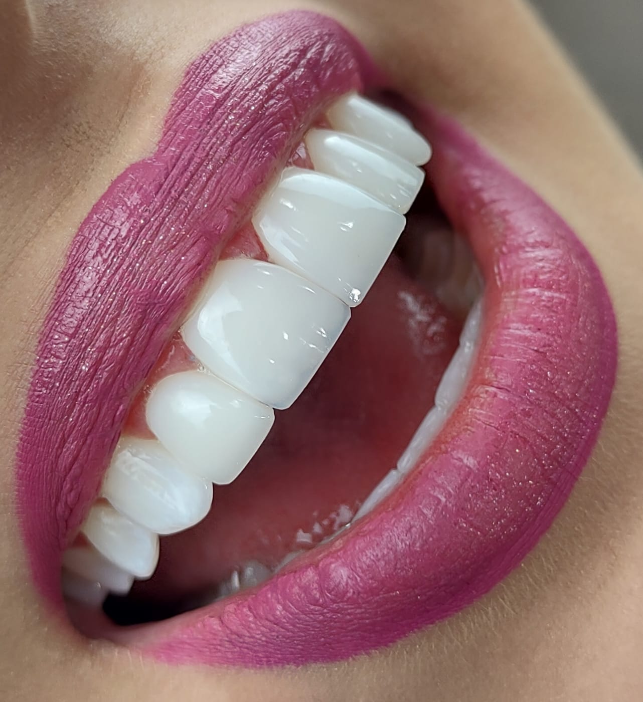Implante dentário Straumann