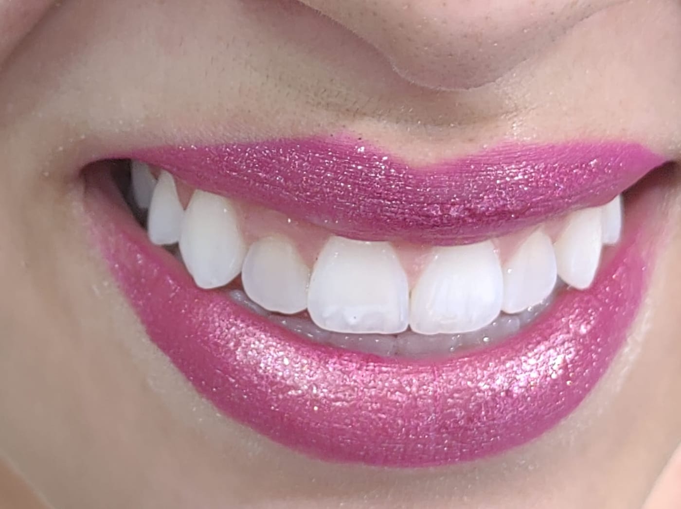 Lentes de contato dental